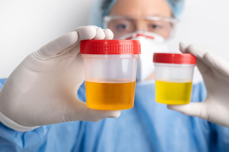 Urinalysis and Its Role in Medical Diagnosis